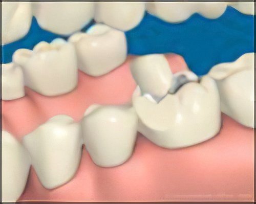 Couronne Dentaire Le Fossat Fracture-Dentaire-Petite