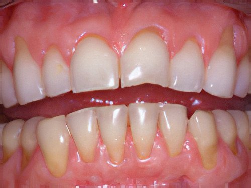 Esthétique du sourire le Fossat Eclaircissement Dentaire 1