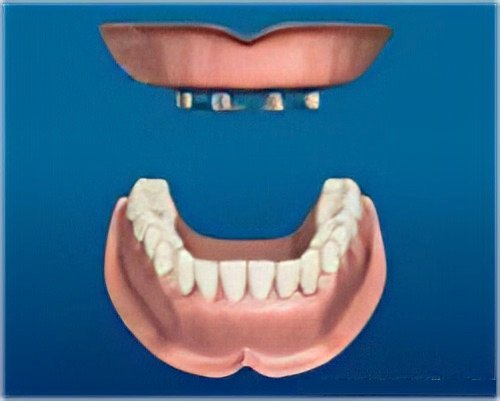 implants dentaires Le Fossat appareil dentaire complet