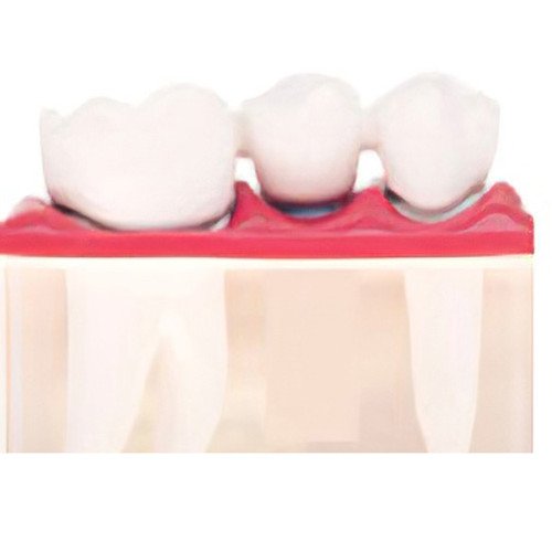 Remplacement dents Le Fossat